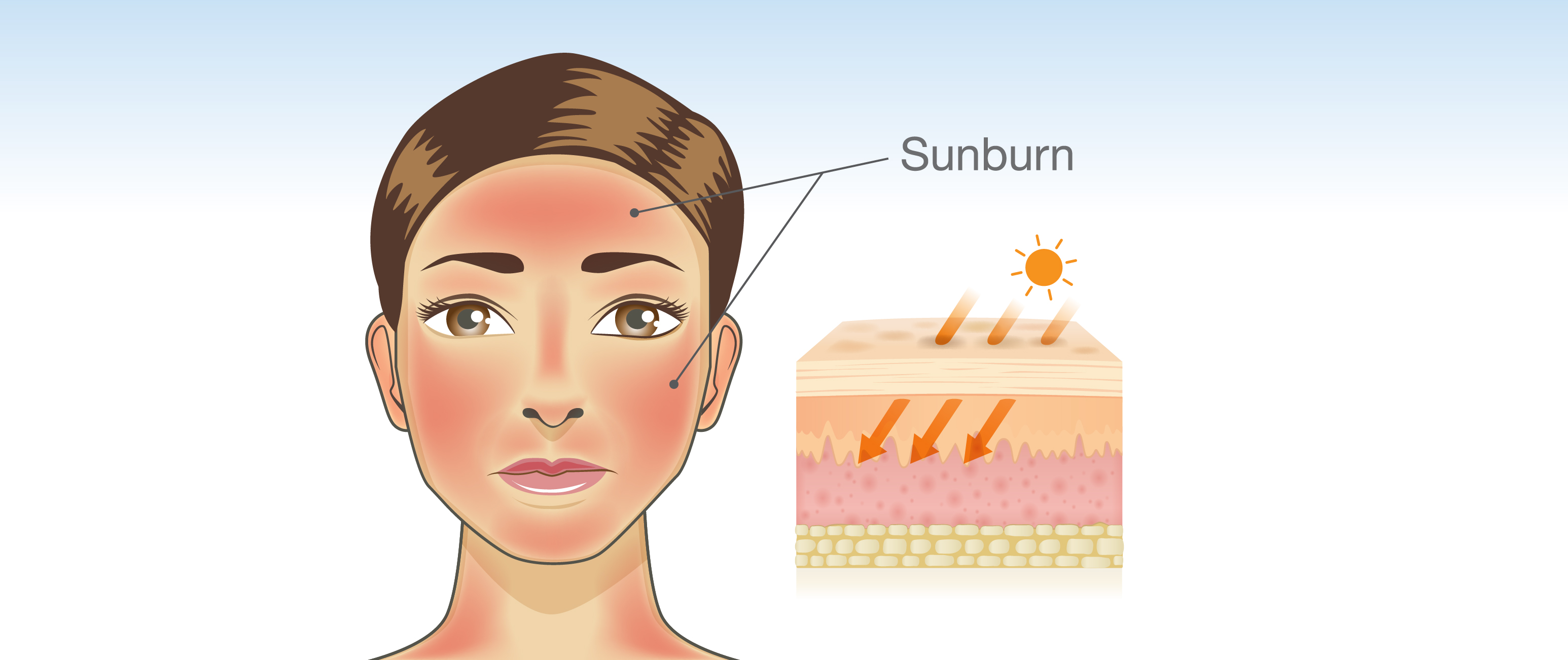 Sunburn after special image